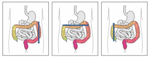 Self-Abdominal Massage 4.png