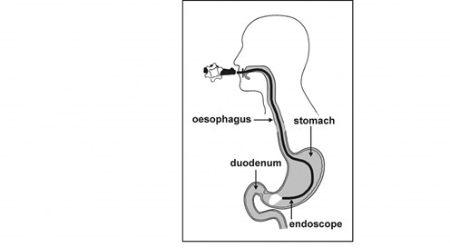 gastroscopy-diagram.jpg